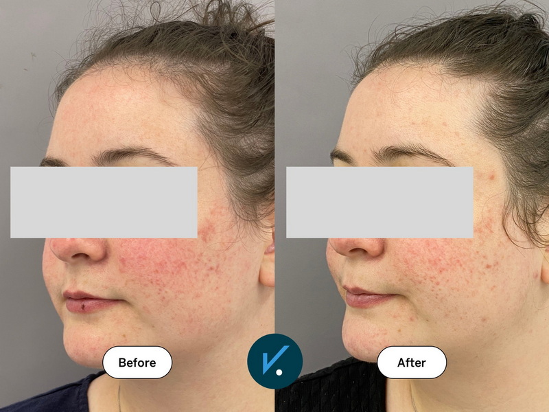 Green Tea Extract Good for Rosacea_1